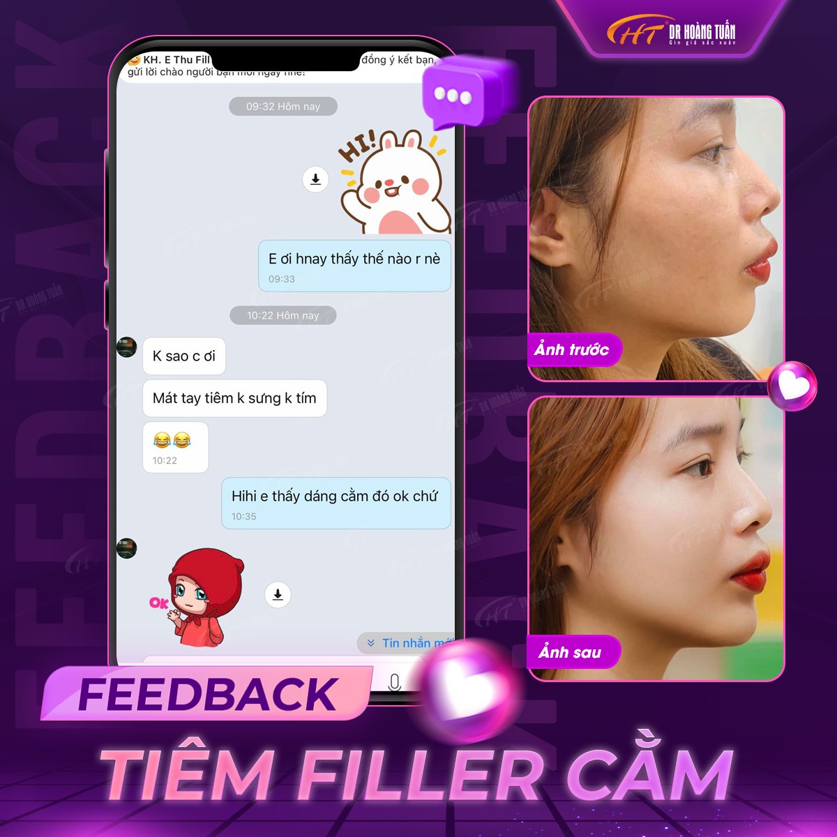 tiêm cằm V Line được bao lâu